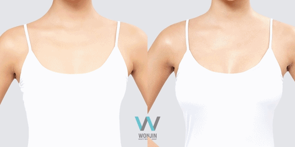 เสริมหน้าอก ทำนม