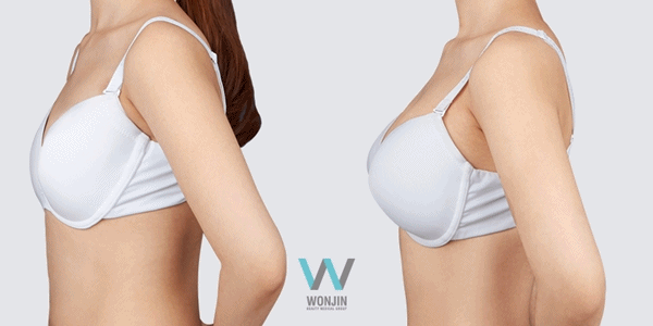 เสริมหน้าอก ทำนม