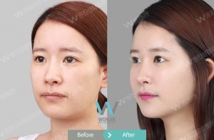 ฉีดไขมันทั่วหน้า