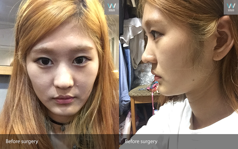 ก่อน หลัง