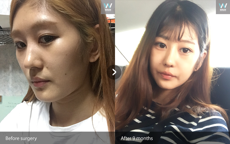 ก่อน และ หลังทำ 9 เดือน