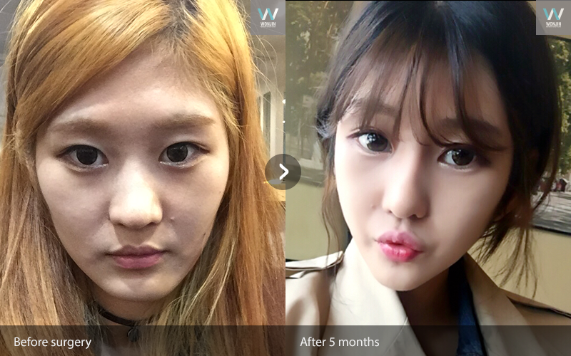 ก่อน และหลังทำ 5 เดือน