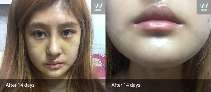 หลัง 14 วัน