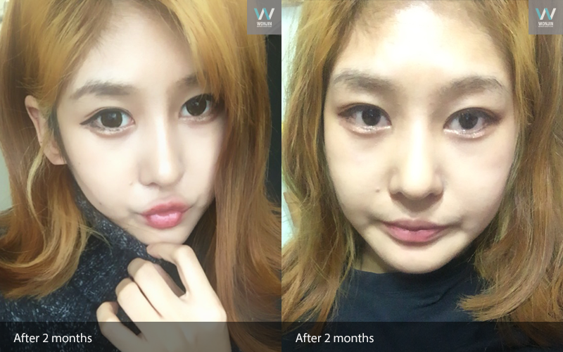 หลัง 2 เดือน