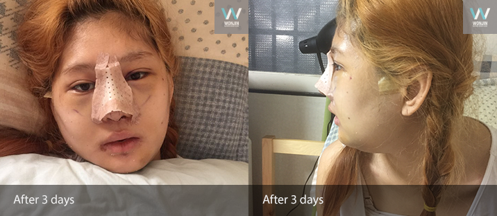 หลัง 3 วัน