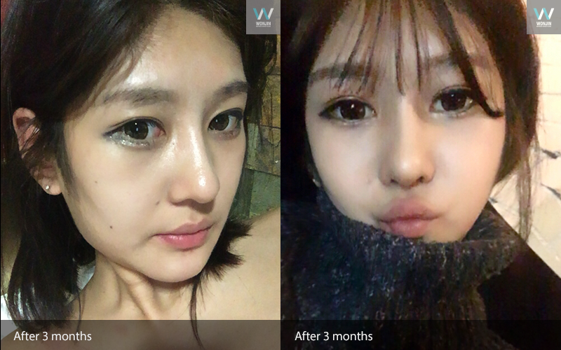 หลัง 3 เดือน