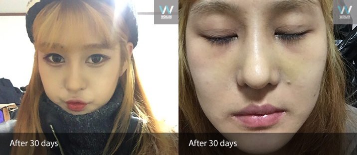 หลัง 30 วัน