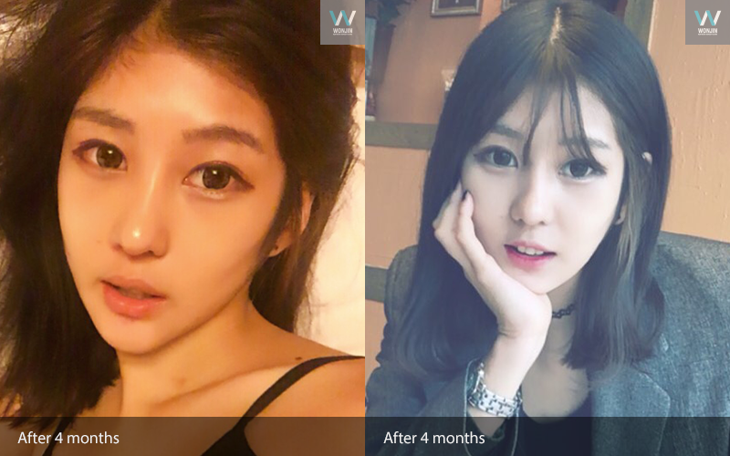 หลัง 4 เดือน