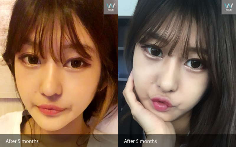 หลัง 5 เดือน