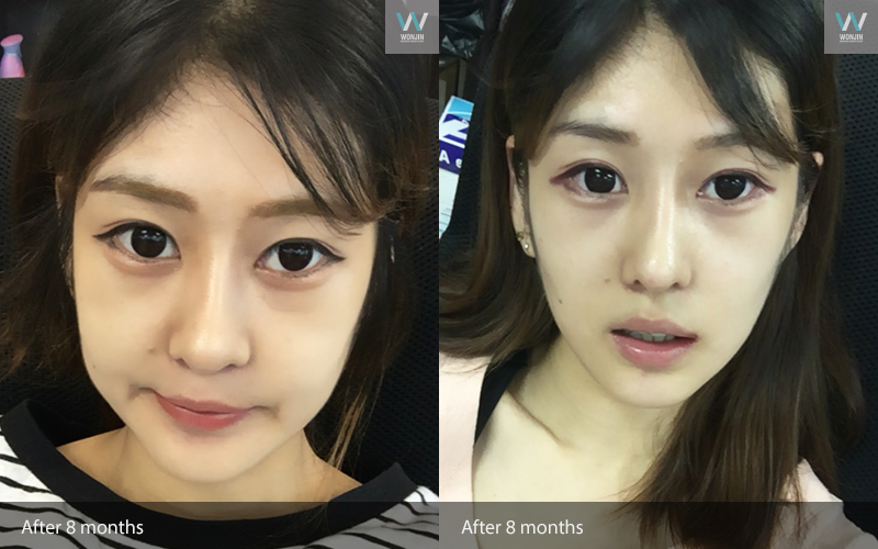 หลัง 8 เดือน