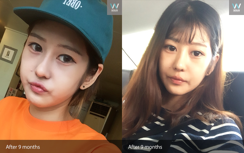 หลัง 9 เดือน