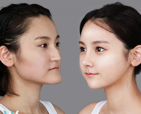 ผ่าตัดขากรรไกร