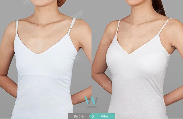 ศัลยกรรมหน้าอกเกาหลี