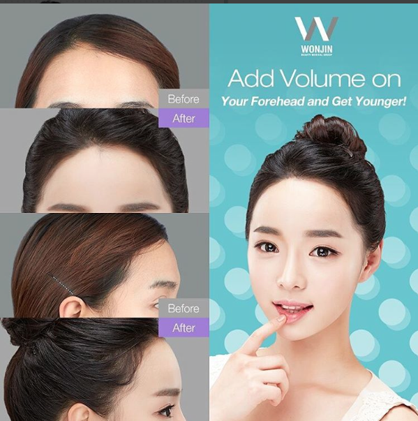 เสริมหน้าผาก