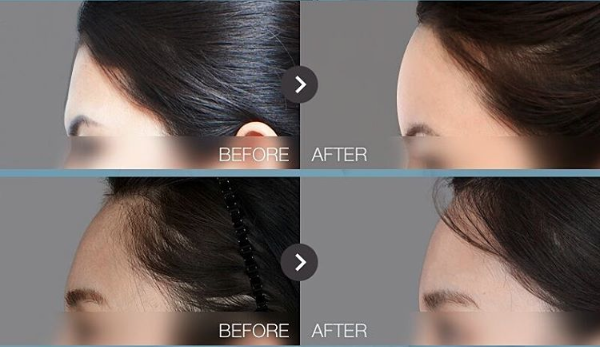 เสริมหน้าผาก