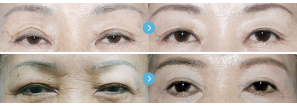 แก้ตาตก