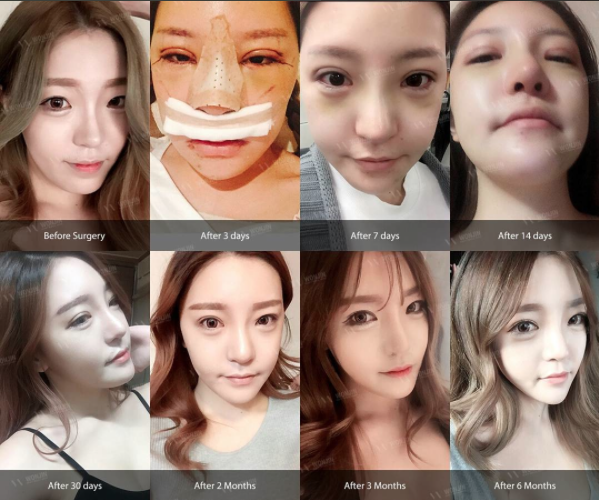 จมูกโด่ง