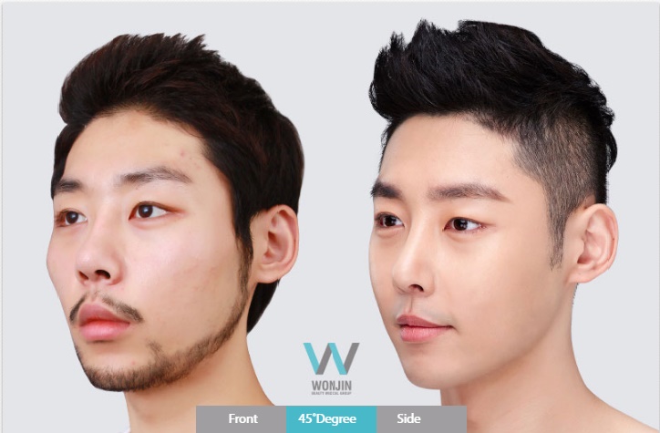 จมูกโด่ง