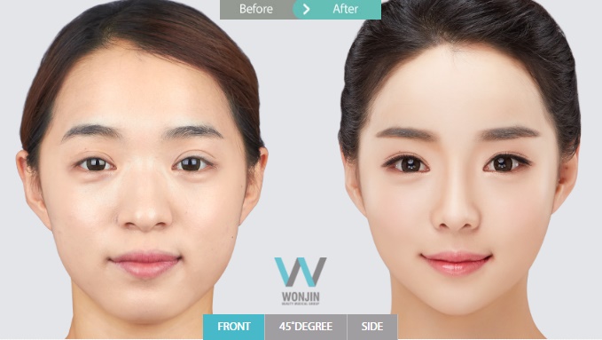 จมูกโด่ง