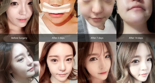 จมูกโด่ง