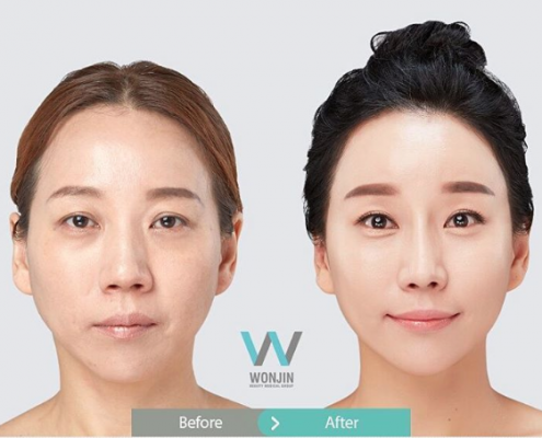 ลดริ้วรอย