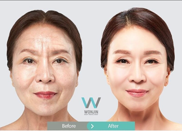 ลดริ้วรอย