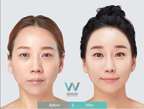 วิธีลดริ้วรอย