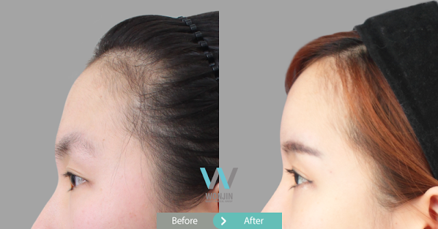 이마보형물 전후사진