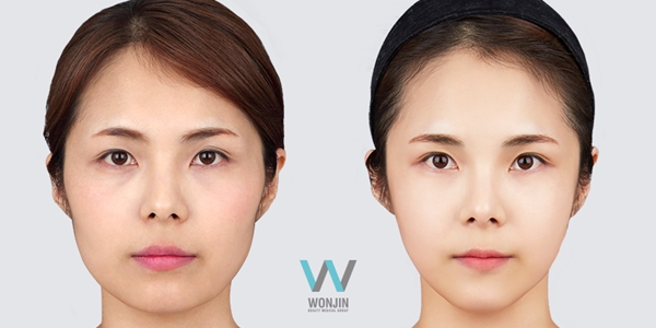 ศัลยกรรมโครงหน้า ตัดกรามเหลี่ยม