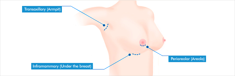 breast-02-03