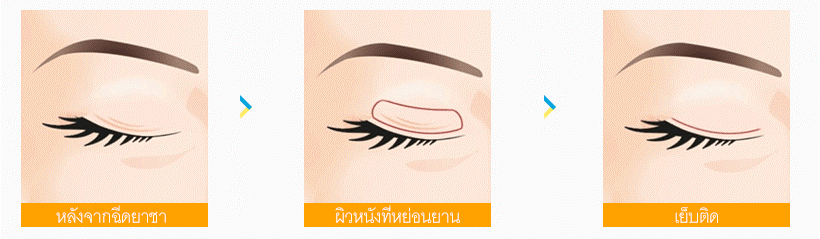 eyelid-06-03-2