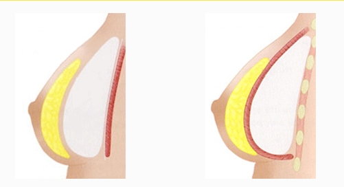 img_breastSurgery05_