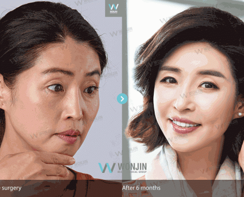 การศัลยกรรมตาวอนจิน