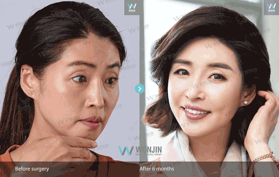 การศัลยกรรมตาวอนจิน