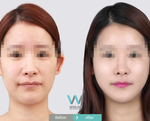 ยกกระชับวอนจิน