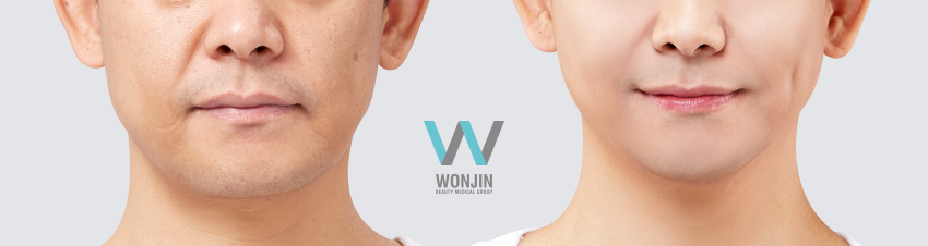 ยกกระชับวอนจิน