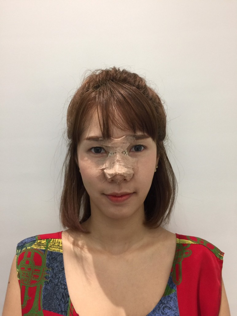 ทำจมูกที่วอนจิน