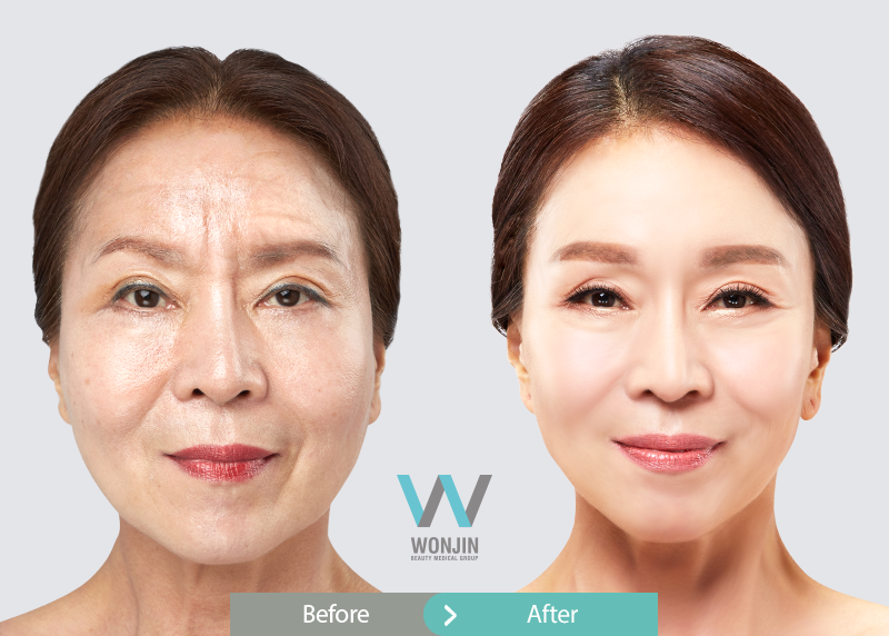 Wint-Lifting-after-005