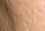 acne_care_02