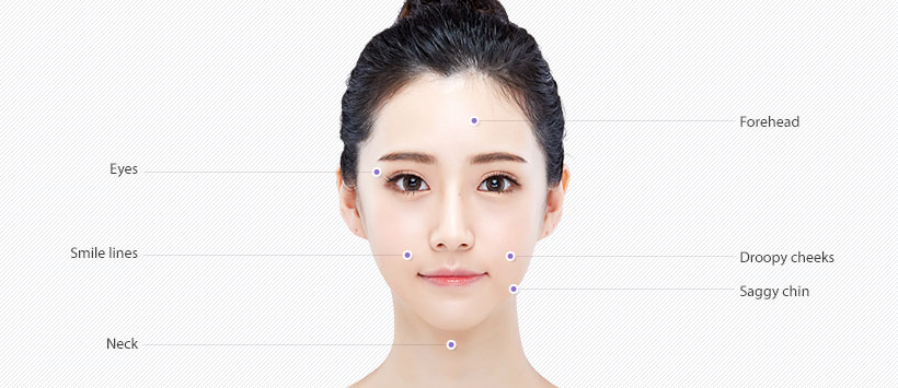 anti-aging-001-threadLift0303