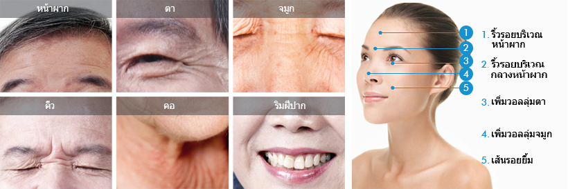 anti-aging-001_botox03