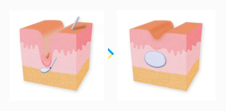 anti-aging-001_filler06