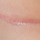 scar_type_img02