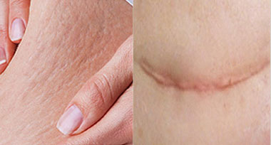 skin_scar