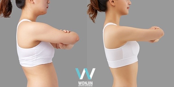 ดูดไขมันวอนจิน