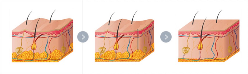 ดูดไขมันCOMPLETE