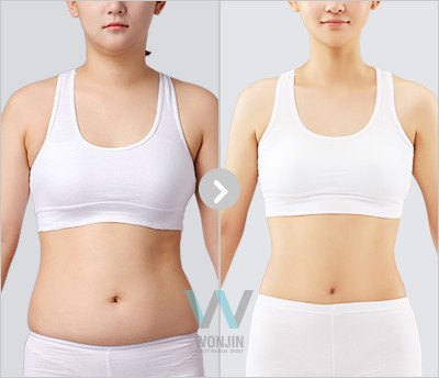 ลดหน้าท้อง