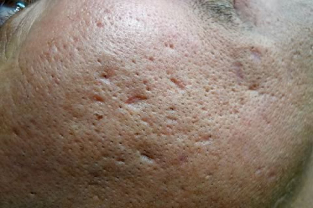 วิธีรักษาหลุมสิว 3