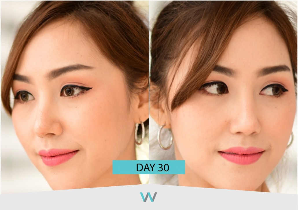 รีวิวจมูก วอนจิน