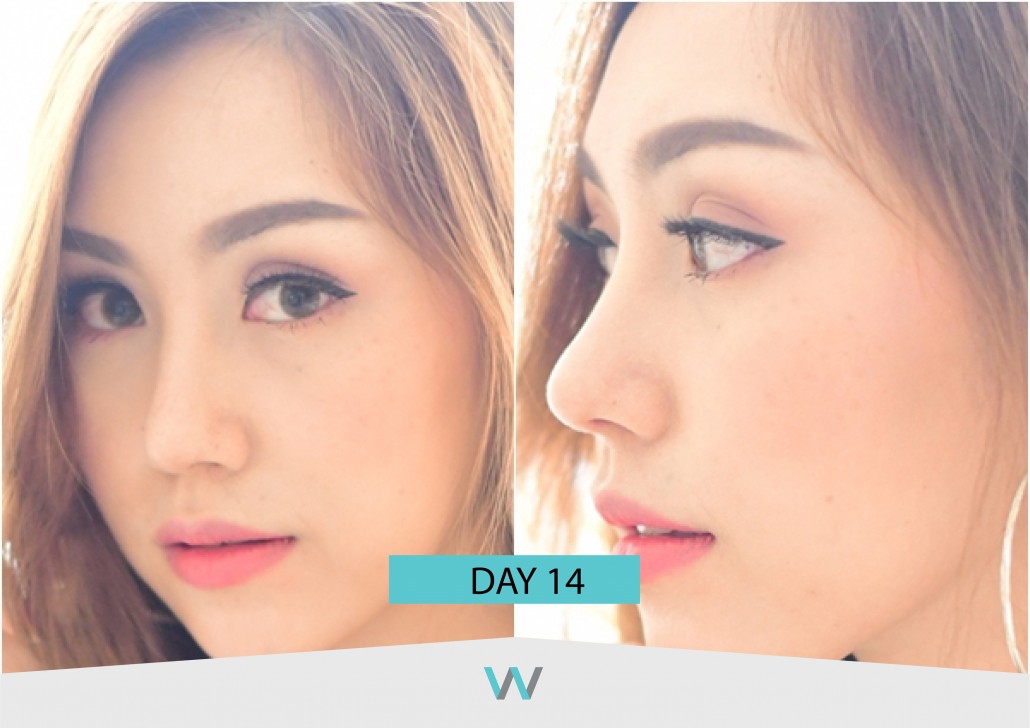 รีวิวจมูก วอนจิน